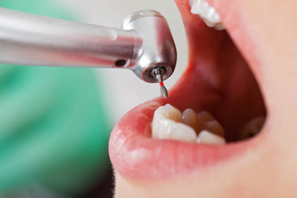 Best Emergency Dental Care for Abscessed Tooth in Foscoe, NC